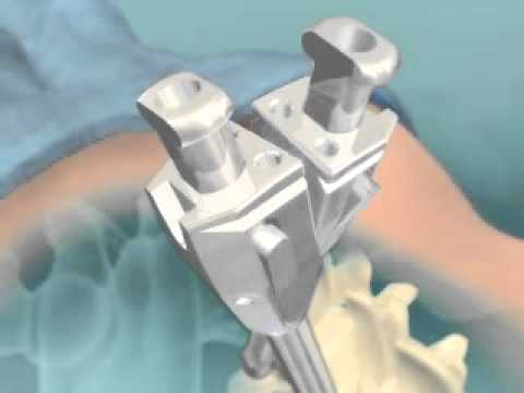 Minimally Invasive Spine Decompression Surgery