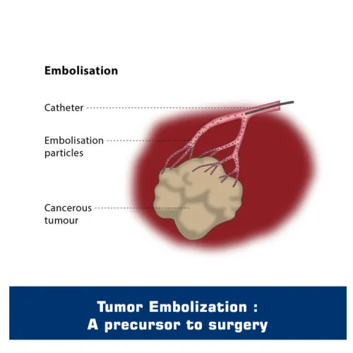 Embolisation